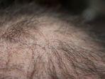 alopecia.jpg