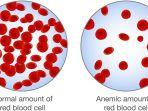 anemia-1.jpg