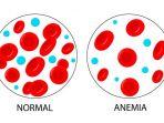 anemia-9.jpg