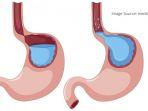 asam-lambung-8.jpg