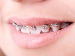 behel-13.jpg