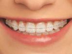 behel-4.jpg