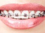 behel-9.jpg