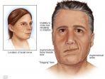 bells-palsy-1.jpg