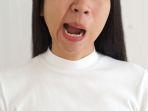 bells-palsy-4.jpg