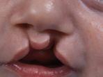 bibir-sumbiing.jpg
