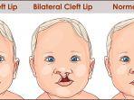 bibir-sumbing-4.jpg