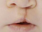 bibir-sumbing-5.jpg