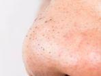 blackhead-2.jpg