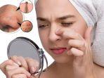 blackhead-3.jpg