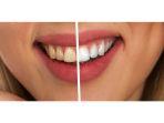 bleaching-gigi-1.jpg