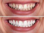 bleaching-gigi-11.jpg