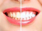 bleaching-gigi-13.jpg