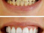 bleaching-gigi-17.jpg