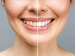 bleaching-gigi-21.jpg