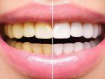 bleaching-gigi-4.jpg