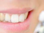 bleaching-gigi-5.jpg