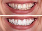 bleaching-gigi-6.jpg