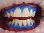 bleeaching-gigi-10.jpg