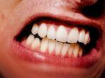 bruxism-6.jpg