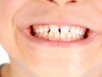 bruxism-9.jpg