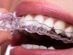 clear-aligner-2.jpg