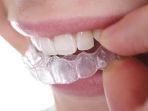 clear-aligner.jpg