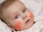 dermatitis-atopik-4.jpg