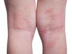 dermatitis-atopik-5.jpg