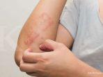 dermatitis-atopik-8.jpg