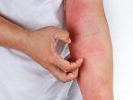 dermatitis-atopik.jpg