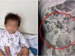 dokter-syok-lihat-hasil-rontgen-balita-usia-2-tahun-ada-8-jarum-tersebar-di-perutnya.jpg