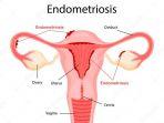 endometriosis-2.jpg