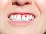 gingivitis-10.jpg