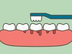 gingivitis-13.jpg