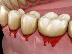 gingivitis-14.jpg