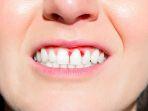 gingivitis-16.jpg