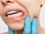 gingivitis-17.jpg