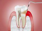 gingivitis-3.jpg