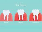 gingivitis-5.jpg