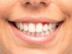 gingivitis-7.jpg