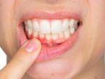 gingivitis-8.jpg