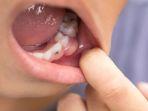 gusi-abses-11.jpg