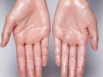 hiperhidrosis-2.jpg