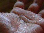 hiperhidrosis-6.jpg