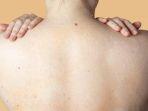 ilustrasi-adanya-jerawat-punggung-atau-back-acne.jpg
