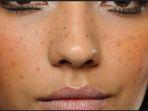 ilustrasi-adanya-melasma-atau-flek-hitam.jpg