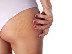 ilustrasi-adanya-stretch-mark.jpg