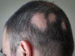ilustrasi-alopecia.jpg