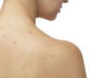 ilustrasi-back-acne-atau-jerawat-punggung.jpg